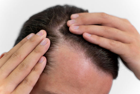 Why are sulfate-free shampoos prescribed after hair transplant?